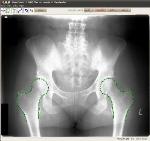 New Software Automatically Outlines Bones in Radiograph Images