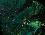 Combinatorial Imaging Could Help Diagnose Pre-Cancerous, Cancerous Conditions in Ascending Colon