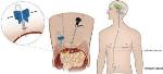 Laparoscopically Assisted Ventriculoperitoneal Shunt Placement May Be Better Than Mini-Laparotomy