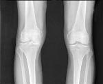 Breakthrough Fluorescent Probe Shows Promise to Facilitate Osteoarthritis Diagnosis and Monitoring