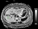 New MRI Technique to Better Detect, Evaluate NAFLD in Children