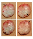 Raman Spectroscopy Can Successfully Detect Cancerous Tissue Following Laser Ablation