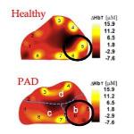 New Vascular Optical Tomographic Imaging System to Diagnose, Monitor Peripheral Artery Disease