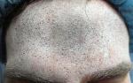 3D Imaging Technique May Help Measure Efficacy of Injectable Wrinkle Reducers