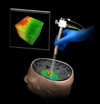 OCT-Based Imaging Technique Could Help Differentiate Brain Tumor from Noncancerous Tissue