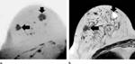 Abbreviated MR Breast Imaging Protocol Could Reduce Unnecessary Biopsies