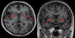 Patient with Depression Treated Non-Invasively with Focused Ultrasound