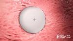 Specialized UV-Light Enabled Catheter Can Non-Invasively Fix Holes in the Heart