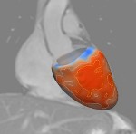 Specialised MRI Scans Show Earliest Signs of Damage to the Heart