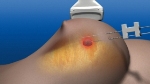 Novilase Laser Breast Therapy Shows Promise for Treatment of Small Breast Cancers