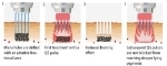 Fotona Granted Patent for FracTat Method for Lightening or Eradicating Pigments in Human Skin