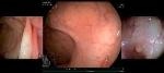 Third Eye Panoramic Device Gets FDA Clearance for Use as Resposable Product for Colonoscopies