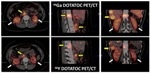 New Molecular Imaging Technique Allows Oncologists to Optimize Radiotherapy Dose