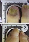 Toenail Fungus Sufferers Can Now Enjoy Clear Nail Beds with New FDA-Approved Laser Treatment
