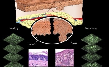 Non-Invasive Imaging Technique Could Accurately Detect Skin Cancer Without Surgical Biopsy
