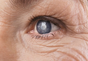 Mann Eye Institute Performs Cataract Surgery with Futuristic CATALYS Laser