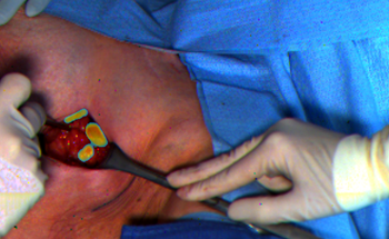 Nature-Inspired Compact and Economical Camera Helps Surgeons See Cancer Cells