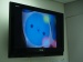 Changing the Face of Corneal Eye Transplant Surgery