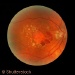 Link Between Gene and Cause of Blindness