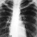 UV Light Could Slash TB Transmission