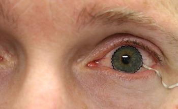 New Contact Lens Technology to Help Diagnose and Monitor Medical Conditions