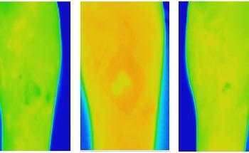 New Thermal Imaging Technique can Improve Chronic Wound Care
