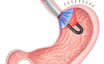 Researchers Develop a Nonsurgical Implant to Treat People with Obesity