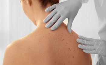 Opportunities in Melanoma Diagnosis Using Surface-Enhanced Raman Scattering Biosensor