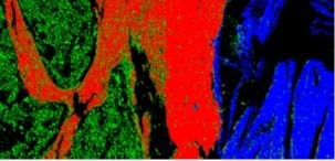 A New Approach for a Label-Free and Non-Invasive Clinical Device
