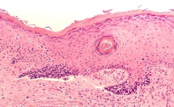 Study Develops Novel Handheld Optical Polarization Skin Cancer Imager