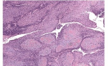 Novel Imaging Technology Identifies Cancerous Bone Tissue