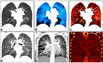 Photon-Counting CT Enhances Assessment of Lung Structure and Function