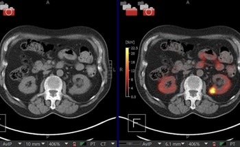 AI-Powered Kidney Cancer Detection