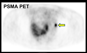 PSMA-PET Challenges Traditional Staging of High-Risk Prostate Cancer