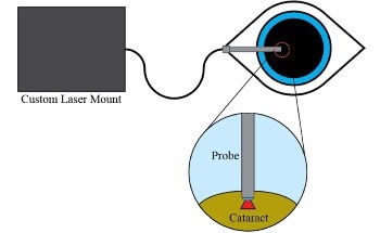 Affordable Laser System Revolutionizes Cataract Removal