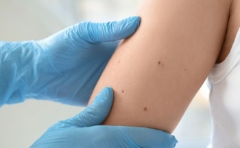 AI-Powered Handheld Scanner Detects Skin Cancer Without Biopsy